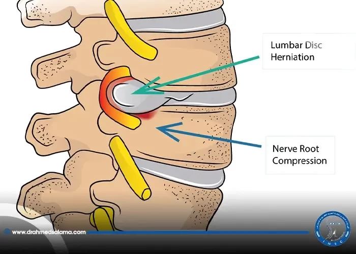 انزلاق غضروفي الفقرة الخامسة والعجزية image